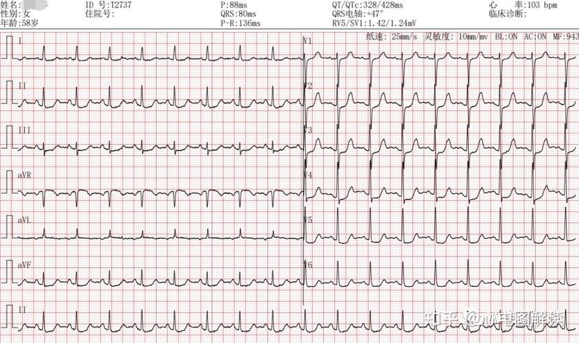 心肌缺血心电图可以显示吗