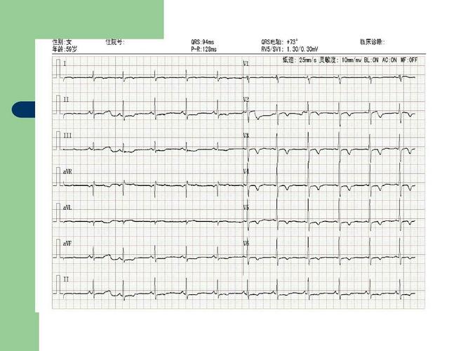 心肌缺血心电图可以检查吗