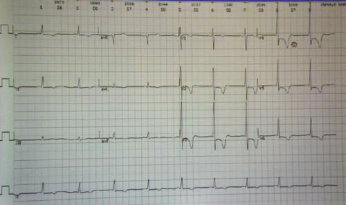 心肌缺血心电图可以看得出来吗